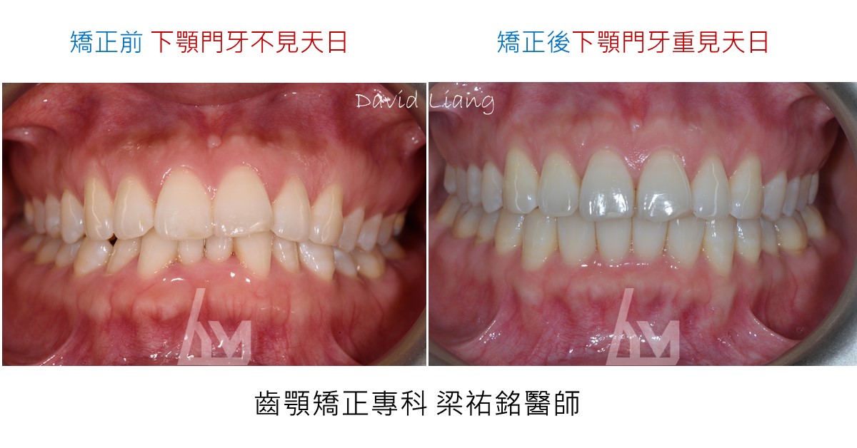 【隱形矯正案例】成人深咬 治療後