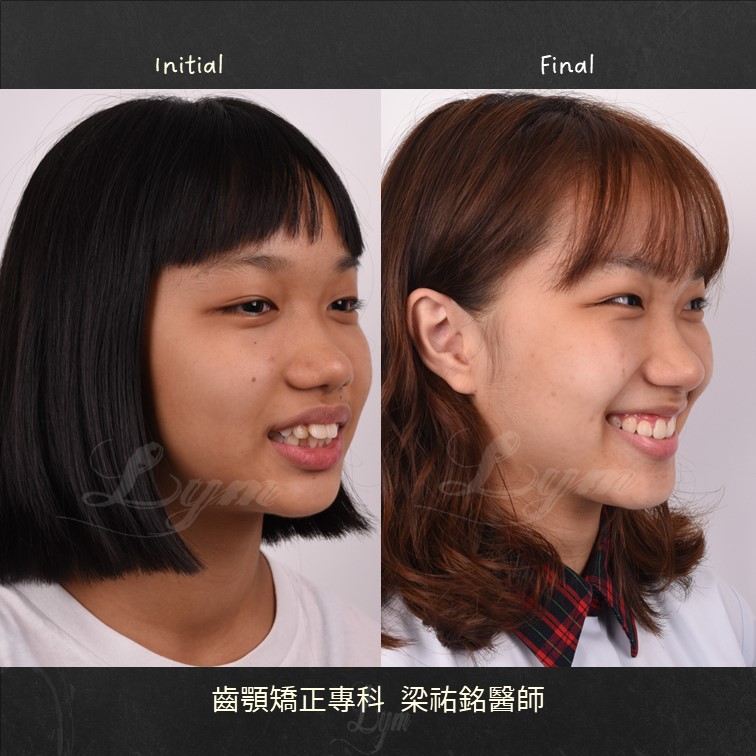 陽光美少女的笑容 治療後