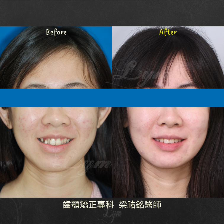 狹窄牙弓合併咬合平面歪斜 治療後
