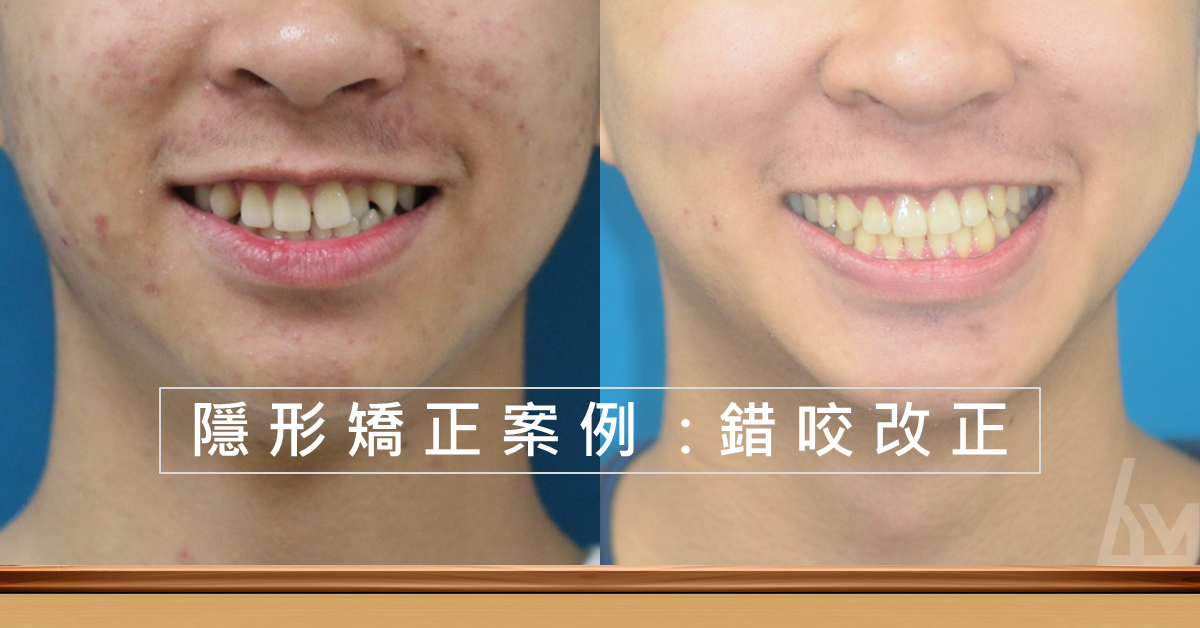 【隱形矯正案例】側門牙錯咬/虎牙歪斜 治療後