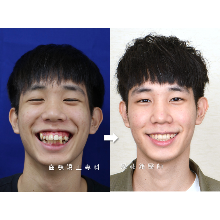 缺牙的男孩【專科協同治療】 治療後