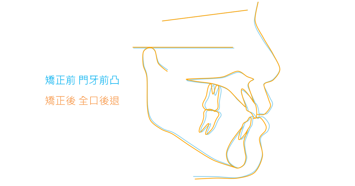 【隱形矯正案例】不拔牙全口後退