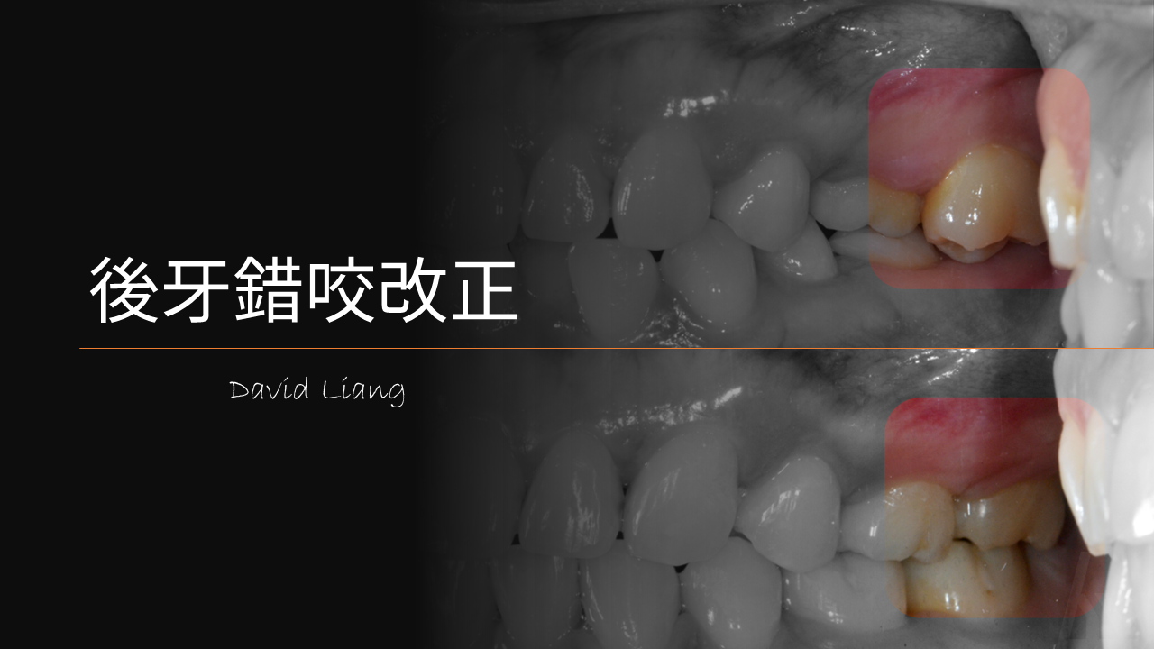 【不能不改的事情】後牙錯咬