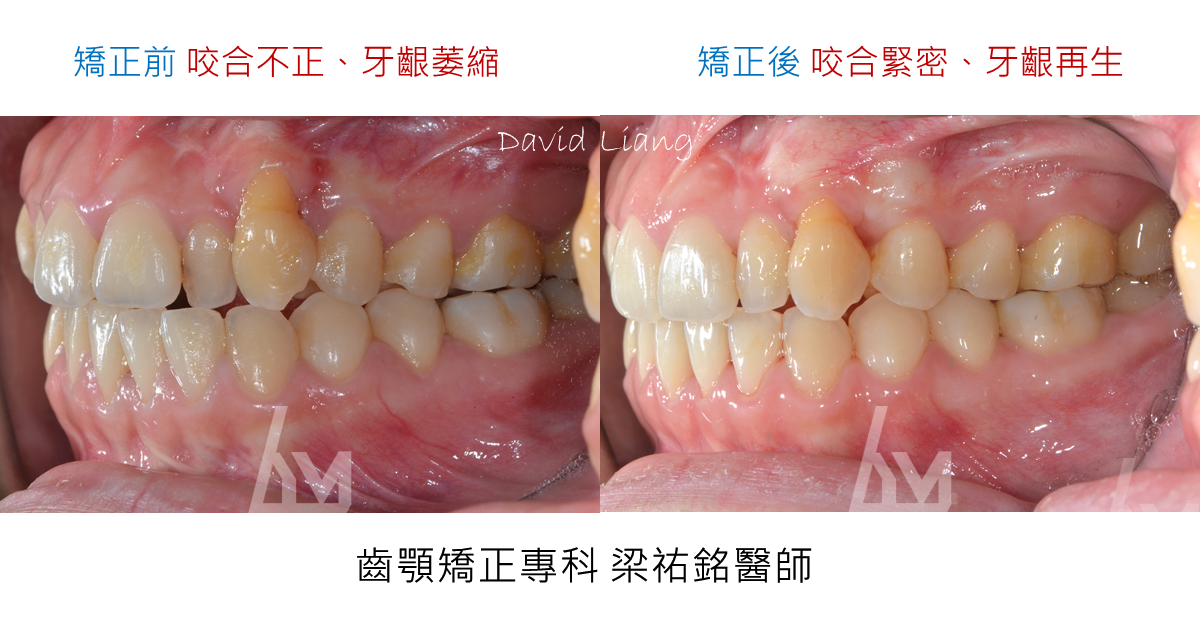 【隱形矯正案例】前牙開咬錯咬/犬齒旋轉/不對稱牙弓 治療後