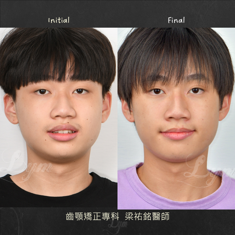 少年的小下巴隱形矯正