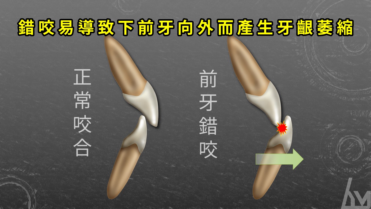 【戽斗系列文章】 早期矯正錯咬的好處