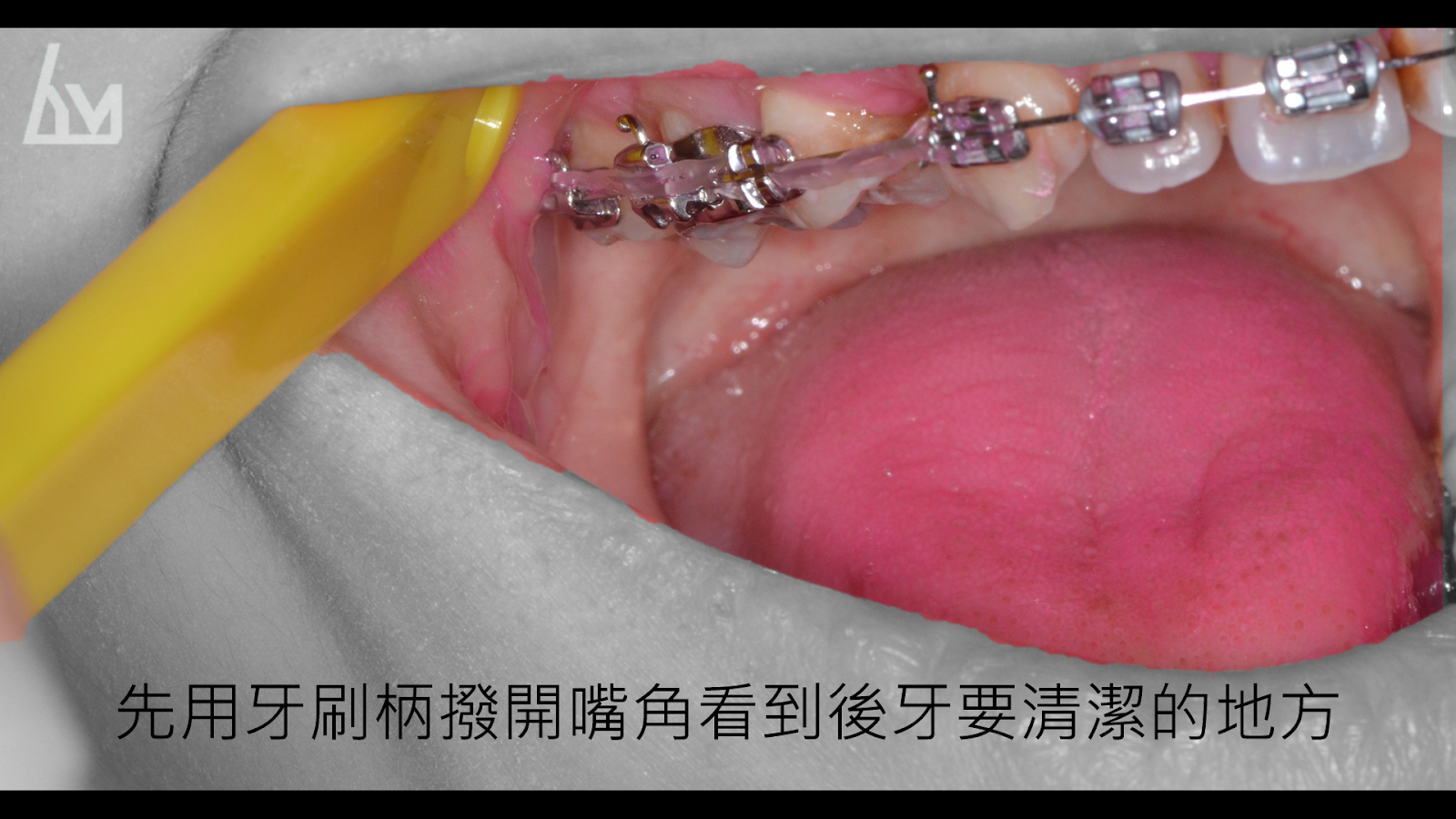 牙齒矯正潔牙秘笈