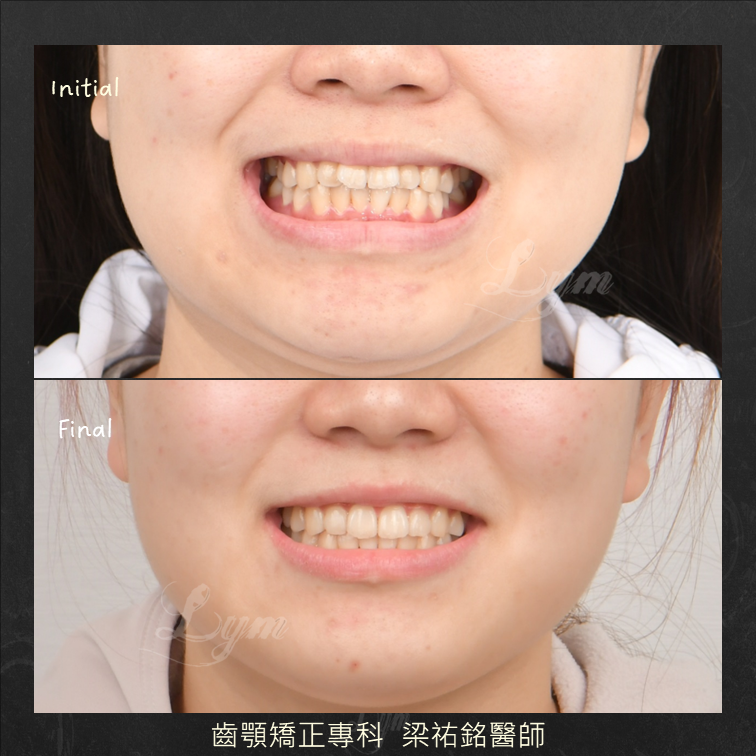 局部隱形矯正